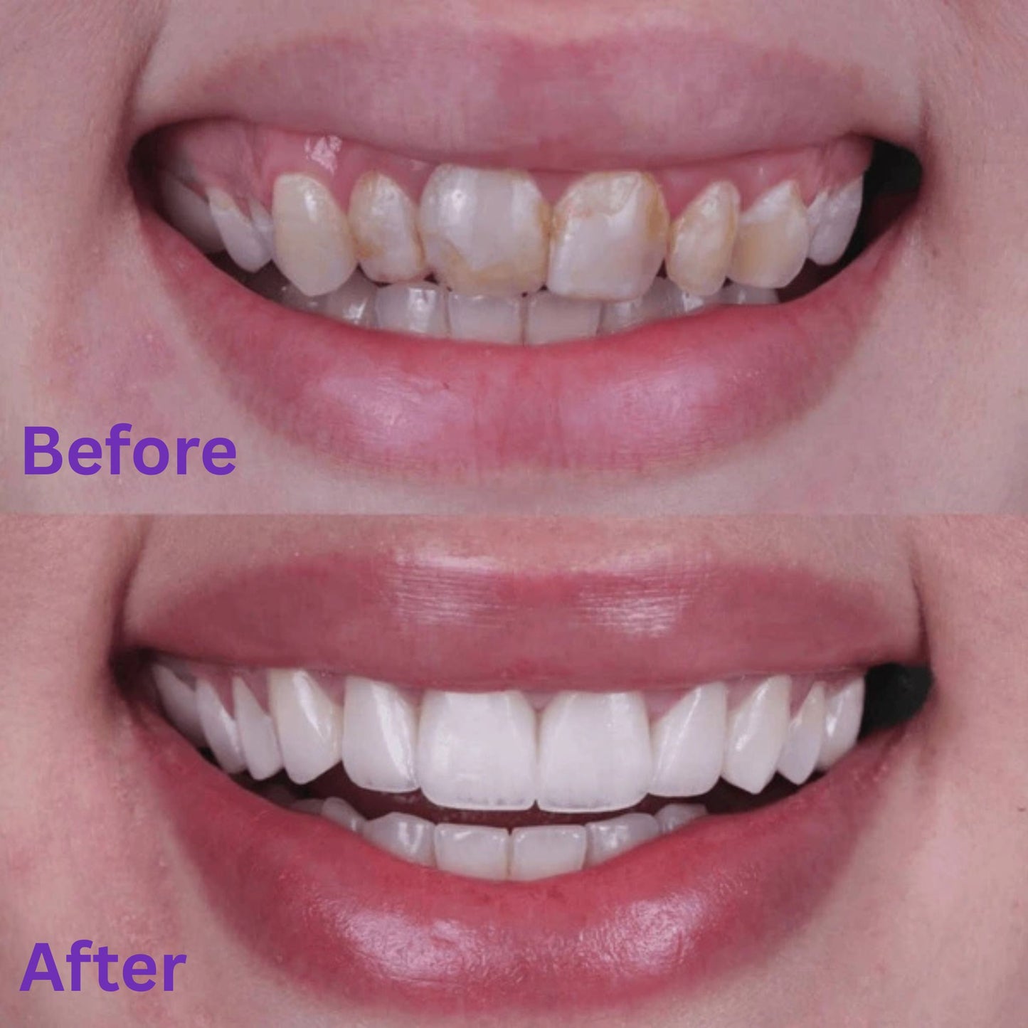 Purelume Whitening Strips