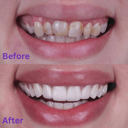 Purelume Whitening Strips