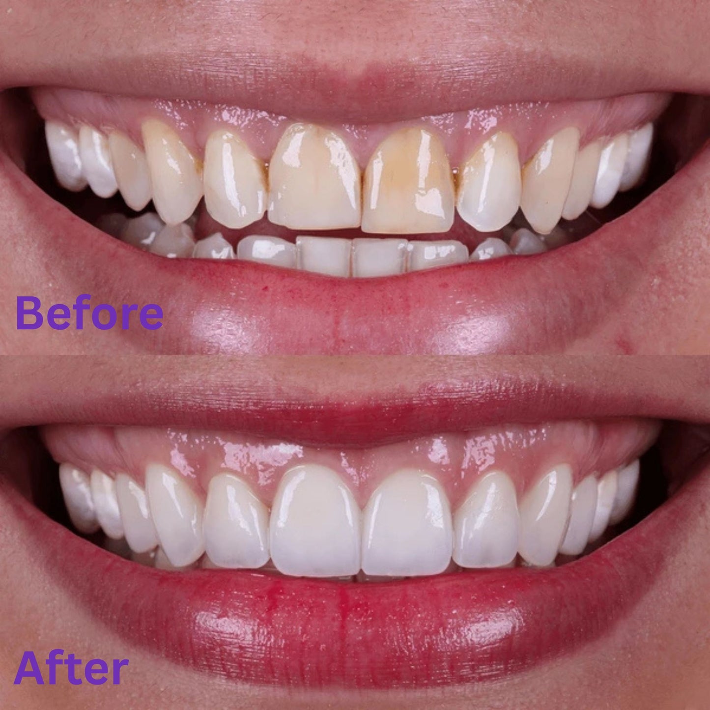Purelume Whitening Strips